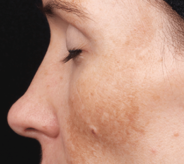 Women with skin showing signs of scabs and spots that's caused by hyperpigmentation.  