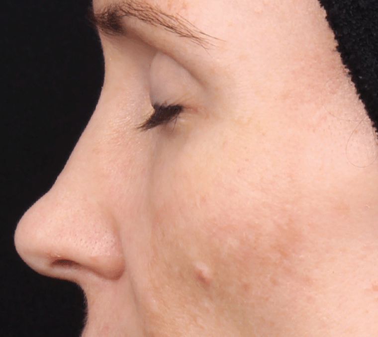 Women with clear skin showing no signs of hyperpigmentation.