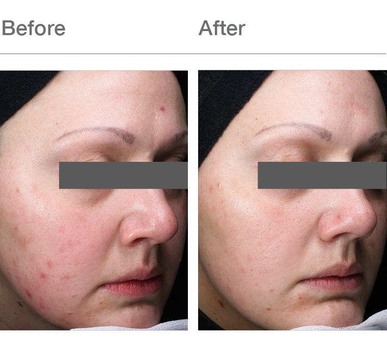 Before and after image showing the possible results of a chemical peel treatment.